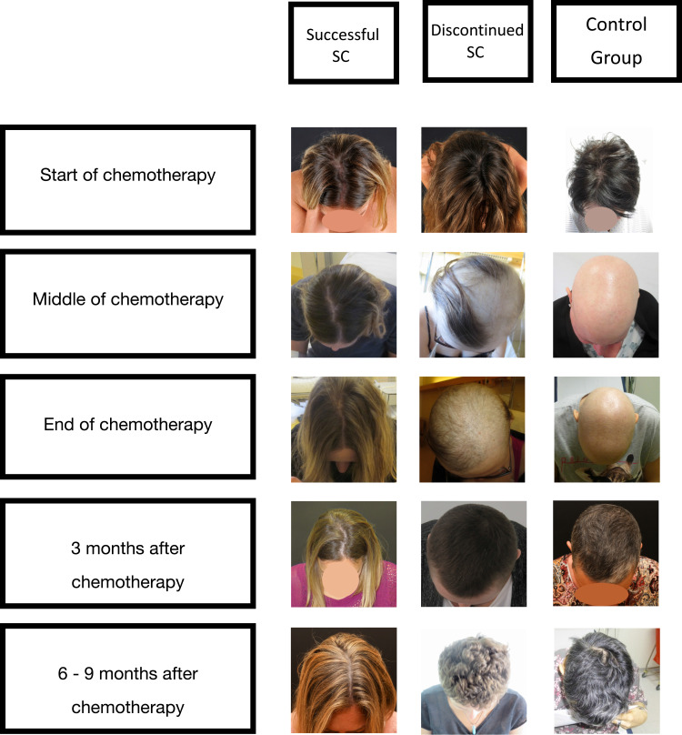 PRO Hair Safe Study: The Patient's Perspective on the Effects of Scalp Cooling on Hair Preservation.