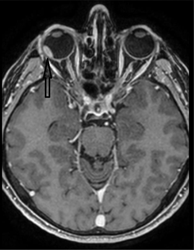 Clinical features and treatment outcomes of progressive uveal melanoma.