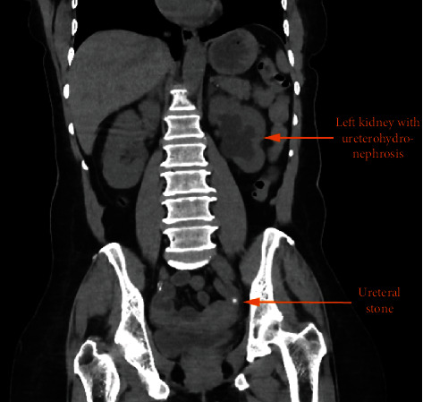 Drug-Induced Urinary Stone of Atazanavir Incidentally Found in an Asymptomatic Patient: A Case Report.