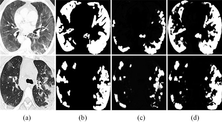 DBF-Net: a semi-supervised dual-task balanced fusion network for segmenting infected regions from lung CT images.