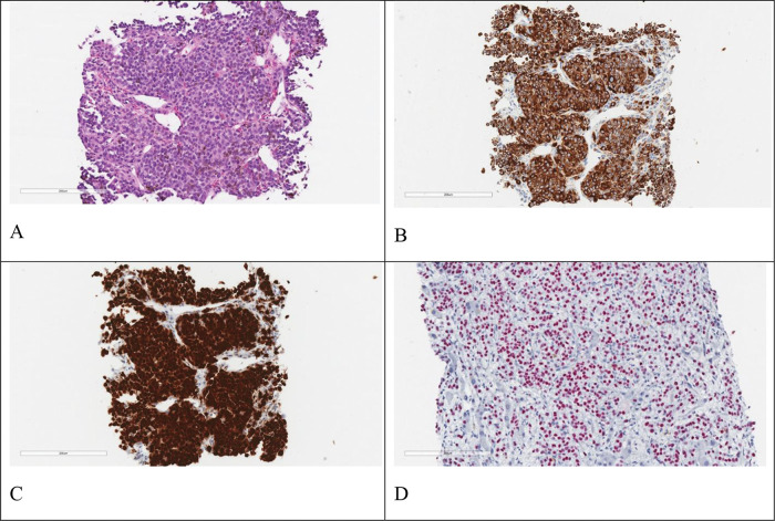 Clinical features and treatment outcomes of progressive uveal melanoma.