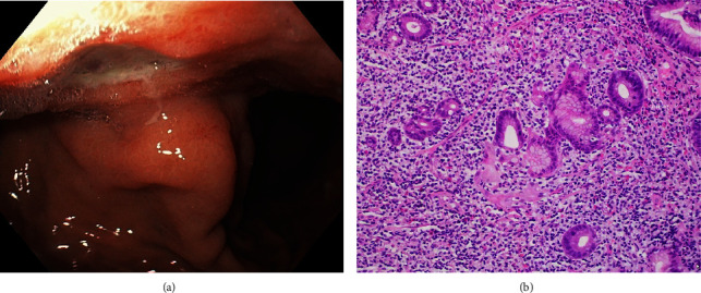 <i>Helicobacter Pylori</i>-Negative MALT Lymphoma: A Series of Two Cases Presenting with Life-Threatening Upper Gastrointestinal Bleeding.