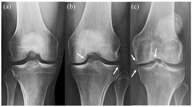 Early knee OA definition-what do we know at this stage? An imaging perspective.