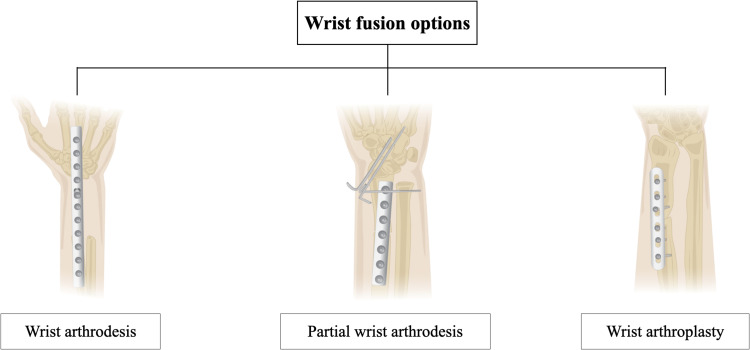 Reconstruction After En Bloc Resection of a Distal Radius Tumor. An Updated and Concise Review.