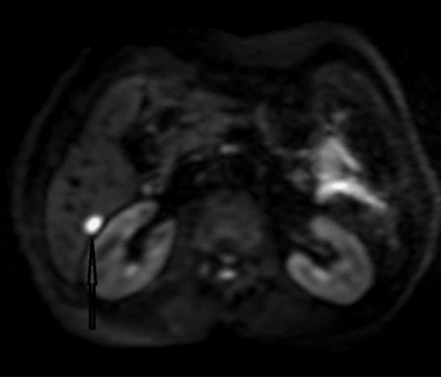 Clinical features and treatment outcomes of progressive uveal melanoma.