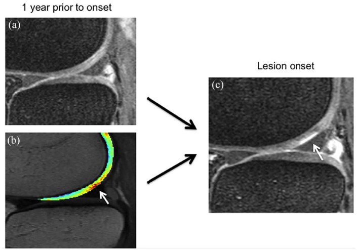 Early knee OA definition-what do we know at this stage? An imaging perspective.