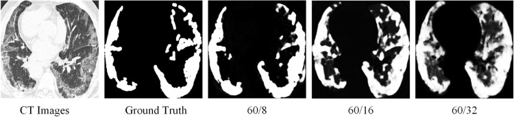 DBF-Net: a semi-supervised dual-task balanced fusion network for segmenting infected regions from lung CT images.