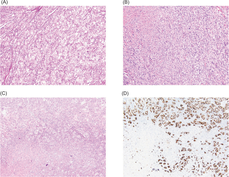 Chromophobe Renal Cell Carcinoma with Sarcomatoid Differentiation.