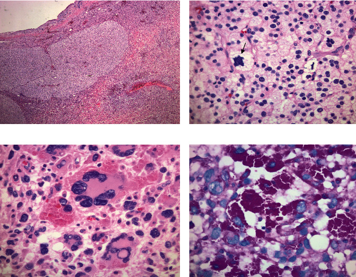 Rare Pleomorphic Liposarcoma Presented as Jejunal Obstruction.