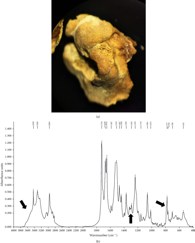 Drug-Induced Urinary Stone of Atazanavir Incidentally Found in an Asymptomatic Patient: A Case Report.