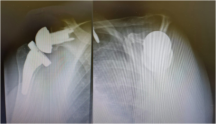 Isolated Large Glenoid Fracture and Acute Glenohumeral Dislocation in Elderly Patients: A Case Series Treated Surgically With Reverse Shoulder Arthroplasty and Augmented Glenoid.