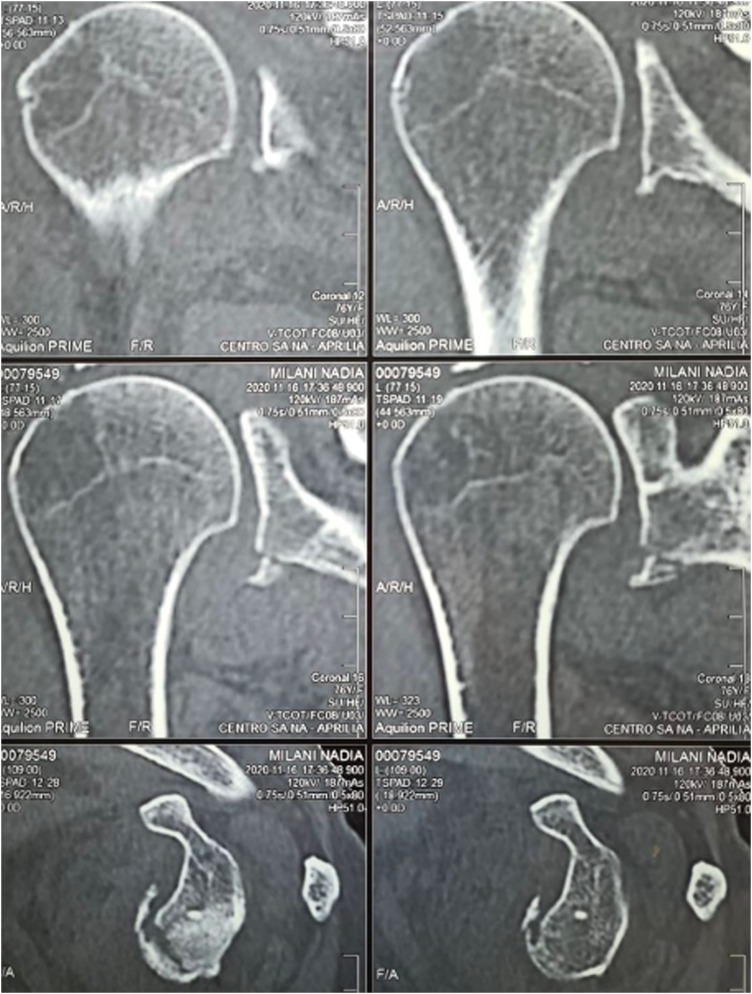 Isolated Large Glenoid Fracture and Acute Glenohumeral Dislocation in Elderly Patients: A Case Series Treated Surgically With Reverse Shoulder Arthroplasty and Augmented Glenoid.