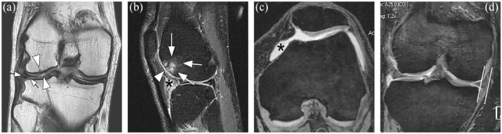 Early knee OA definition-what do we know at this stage? An imaging perspective.