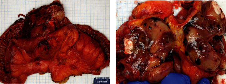 Rare Pleomorphic Liposarcoma Presented as Jejunal Obstruction.