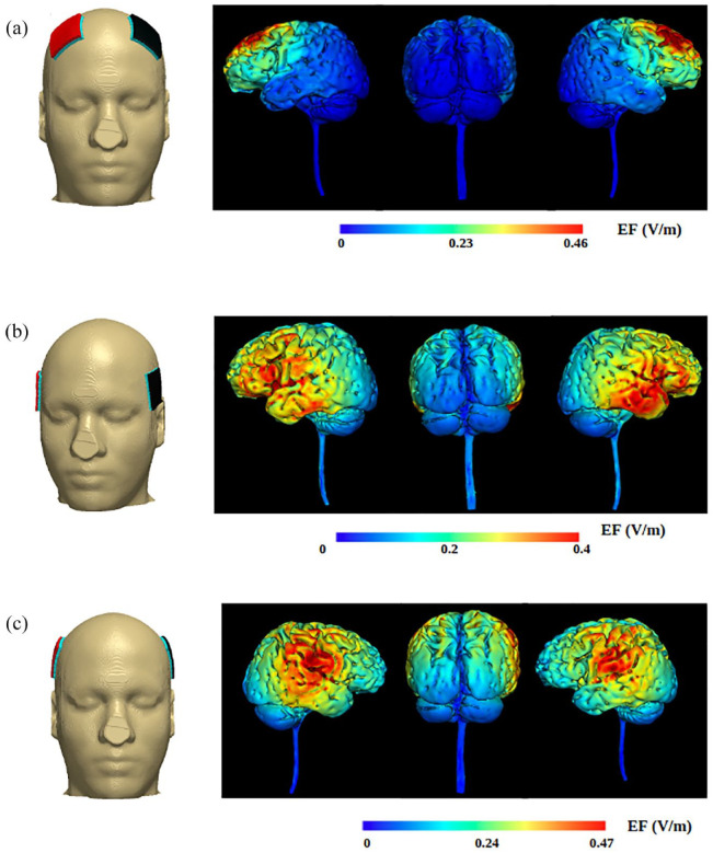 State of the art: non-invasive electrical stimulation for the treatment of chronic tinnitus.