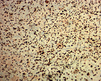 Rare Pleomorphic Liposarcoma Presented as Jejunal Obstruction.