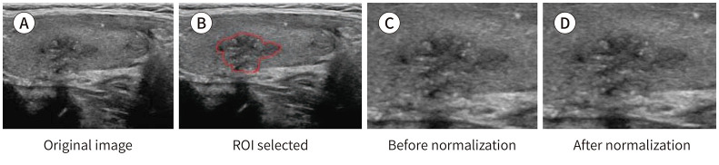 Radiomics Analysis of Gray-Scale Ultrasonographic Images of Papillary Thyroid Carcinoma > 1 cm: Potential Biomarker for the Prediction of Lymph Node Metastasis.