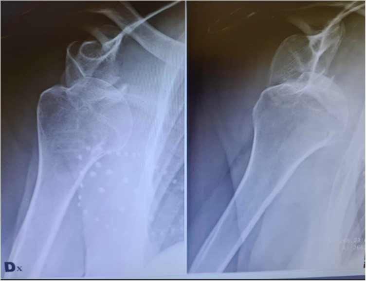 Isolated Large Glenoid Fracture and Acute Glenohumeral Dislocation in Elderly Patients: A Case Series Treated Surgically With Reverse Shoulder Arthroplasty and Augmented Glenoid.