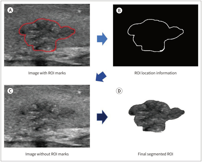 Radiomics Analysis of Gray-Scale Ultrasonographic Images of Papillary Thyroid Carcinoma > 1 cm: Potential Biomarker for the Prediction of Lymph Node Metastasis.