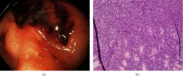 <i>Helicobacter Pylori</i>-Negative MALT Lymphoma: A Series of Two Cases Presenting with Life-Threatening Upper Gastrointestinal Bleeding.