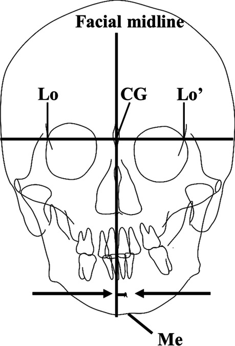 A three-dimensional investigation of mandibular deviation in patients with mandibular prognathism.