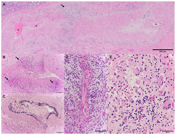 Granulomatosis With Polyangiitis Presenting as an Infratemporal Fossa Mass.