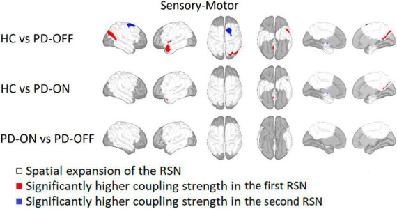 Alterations of PAC-based resting state networks in Parkinson's disease are partially alleviated by levodopa medication.