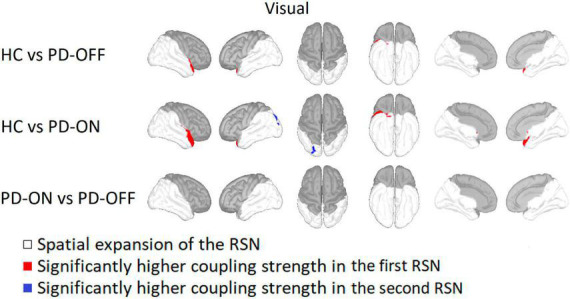 Alterations of PAC-based resting state networks in Parkinson's disease are partially alleviated by levodopa medication.