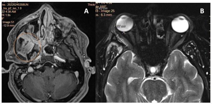 Granulomatosis With Polyangiitis Presenting as an Infratemporal Fossa Mass.