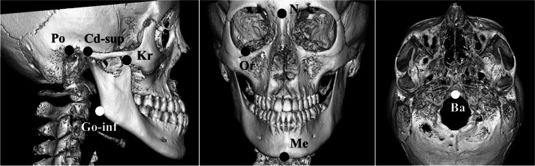 A three-dimensional investigation of mandibular deviation in patients with mandibular prognathism.