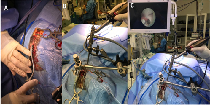 Simultaneous biportal endoscopic management of pineal region tumors in patients with obstructive hydrocephalus: technical notes.