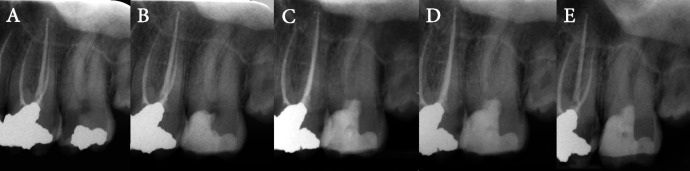 Tampon Pulpotomy: Long-term Successful Results of a Molar with Irreversible Pulpitis and Previous Vital Pulp Therapy Failure.