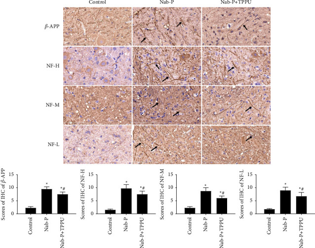 Soluble Epoxide Hydrolase Inhibitor TPPU Alleviates Nab-Paclitaxel-Induced Peripheral Neuropathic Pain via Suppressing NF-<i>κ</i>B Signalling in the Spinal Cord of a Rat.