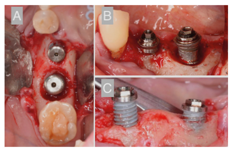 Patient-centered outcomes after surgical treatment of peri-implantitis: a prospective clinical study.