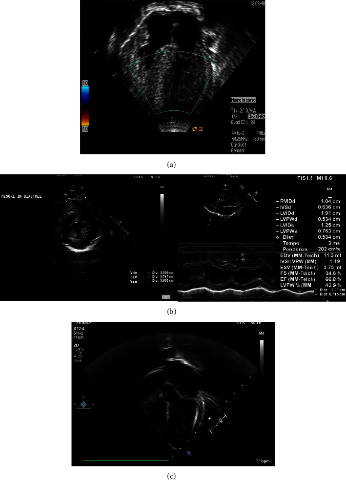 Enzyme Replacement Therapy (ERT) on Heart Function Changes the Outcome in Patients with Infantile-Onset Pompe Disease: A Familial History.