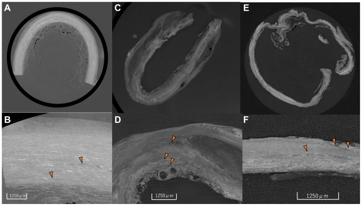 Mechanism of sac expansion without evident endoleak analyzed with X ray phase-contrast tomography