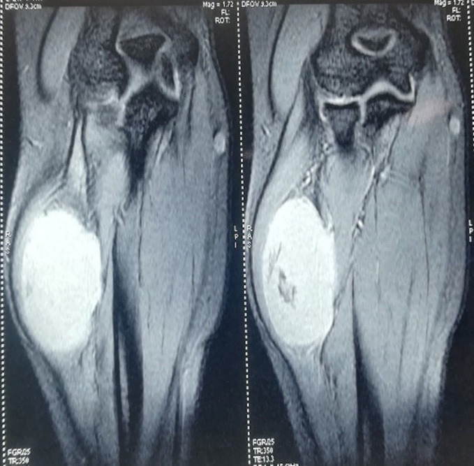 Schwannoma of Posterior Interosseous Nerve: A Case Report and Review of Literature.