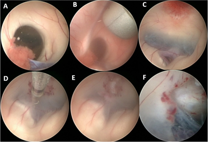 Simultaneous biportal endoscopic management of pineal region tumors in patients with obstructive hydrocephalus: technical notes.