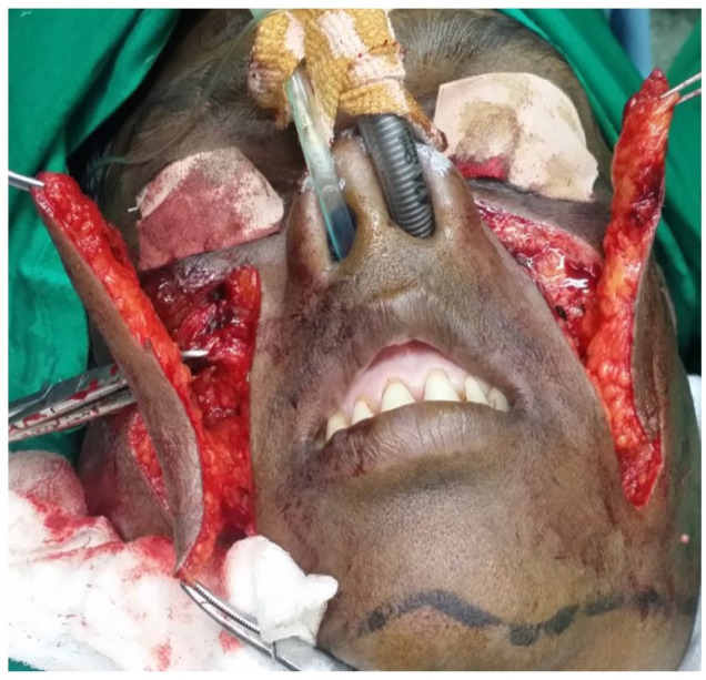 Nasolabial Flap in the Management of Oral Sub Mucous Fibrosis: A Series of Cases.