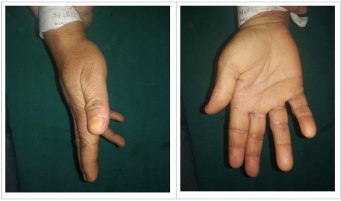 Schwannoma of Posterior Interosseous Nerve: A Case Report and Review of Literature.