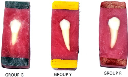 Comparative assessment of surface irregularities of enamel after bonding with different techniques followed by three composite removal methods: An atomic force microscopic study.