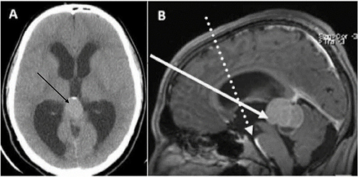 Simultaneous biportal endoscopic management of pineal region tumors in patients with obstructive hydrocephalus: technical notes.