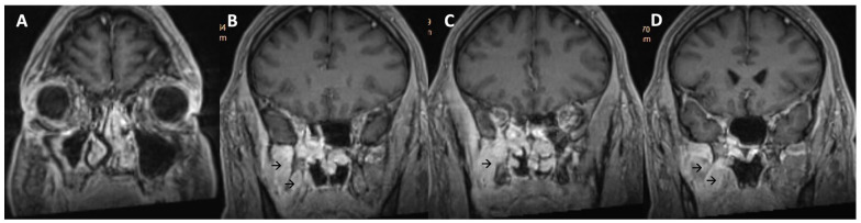 Granulomatosis With Polyangiitis Presenting as an Infratemporal Fossa Mass.