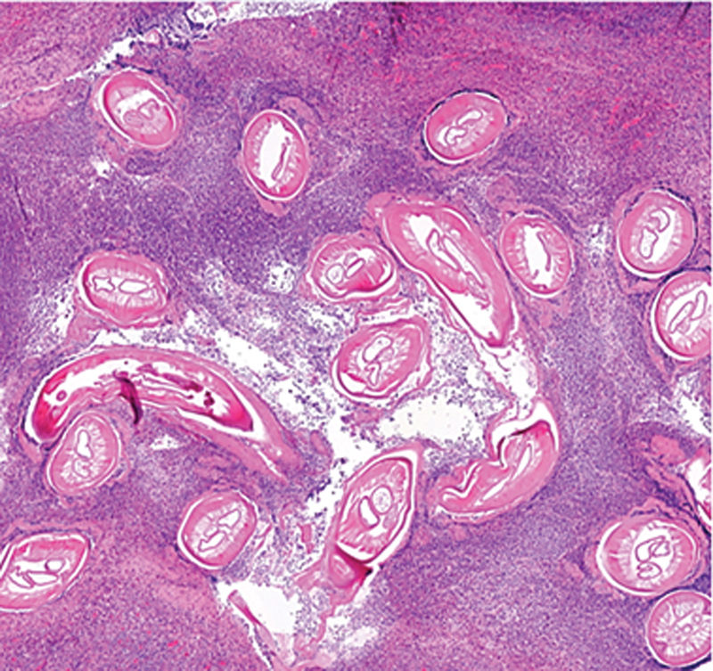 <i>Dirofilaria repens</i> in a Pediatric Patient-First Case Report from Switzerland.