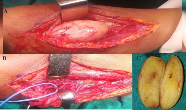 Schwannoma of Posterior Interosseous Nerve: A Case Report and Review of Literature.