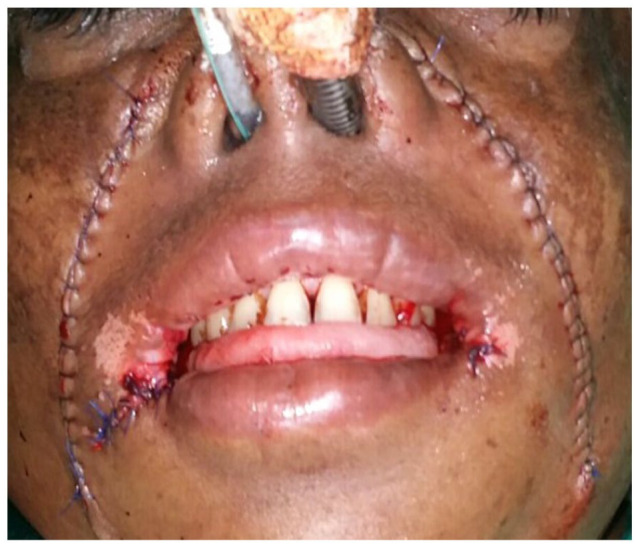 Nasolabial Flap in the Management of Oral Sub Mucous Fibrosis: A Series of Cases.