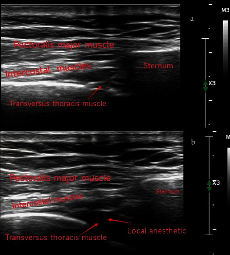 Transversus Thoracis Muscle Plane Block in Paediatric Patients Who Underwent Minimally Invasive Closure of Transthoracic Ventricular Septal Defect: A Retrospective Study.