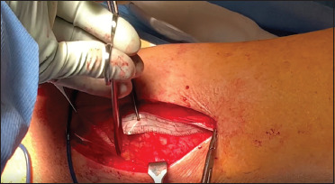 Robotic Sacrocolpopexy with Autologous Fascia Lata: A Case Series.