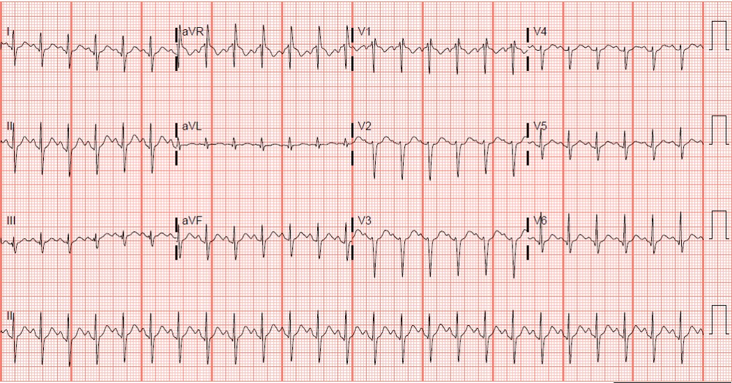 Electrocardiogram Abnormalities Following Diphenhydramine Ingestion: A Case Report.