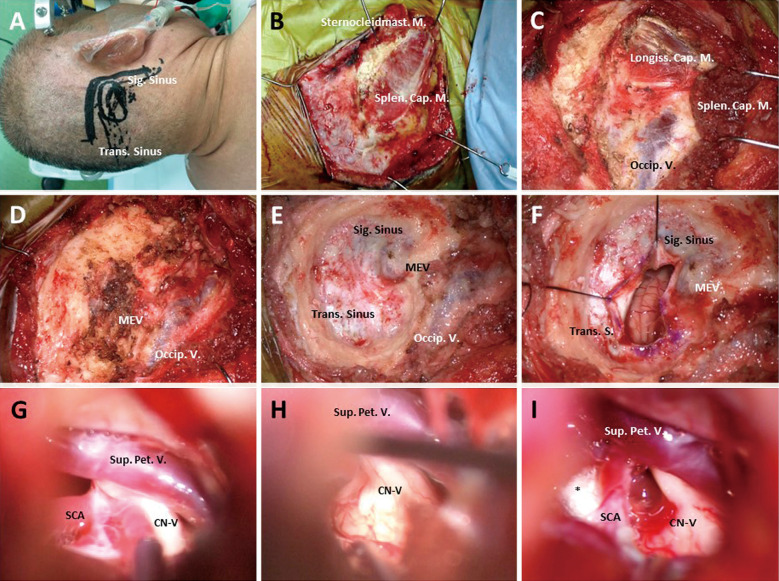 Preservation of Enlarged Mastoid Emissary Vein during Microvascular Decompression for Trigeminal Neuralgia Accompanied by Abnormal Venous Drainage: A Technical Case Report.